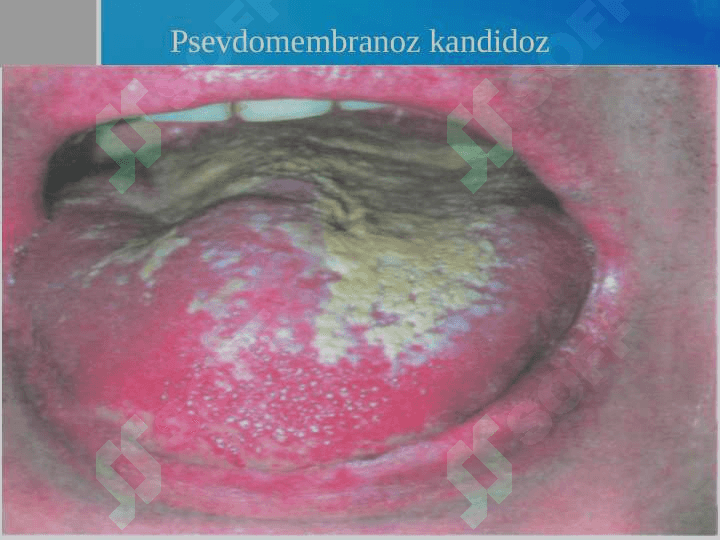 OITSda og’iz bo’shlig’idagi o’zgarishlar. Klinikasi, qiyosiy tashxis, davolash, profilaktika 6