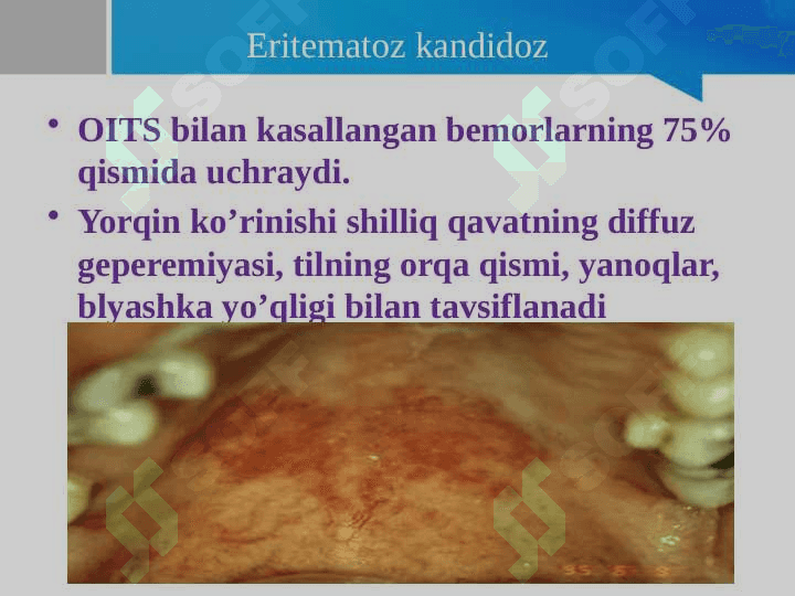 OITSda og’iz bo’shlig’idagi o’zgarishlar. Klinikasi, qiyosiy tashxis, davolash, profilaktika 7