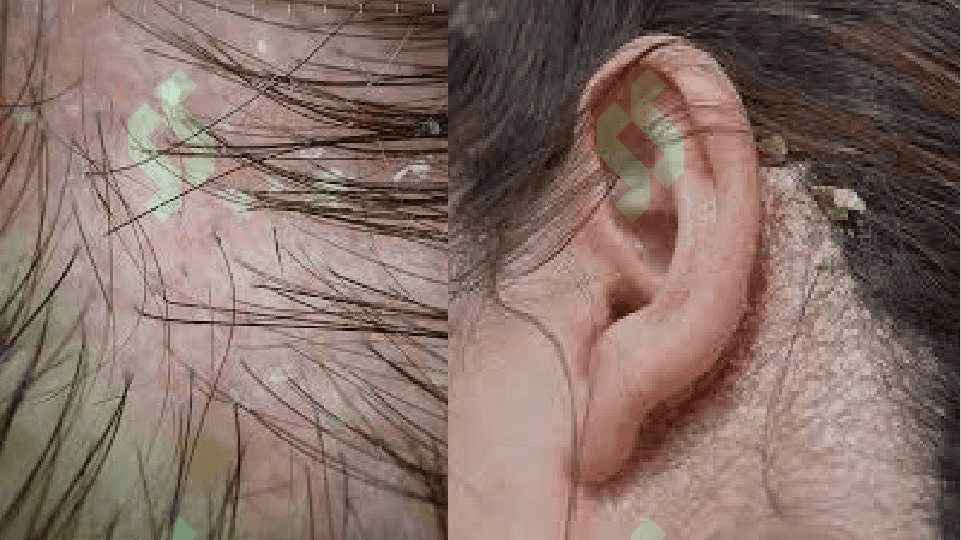 seboreyali dermatit. Pushti xusnbuzar 4