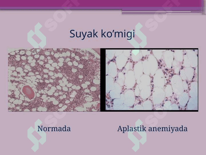 Fankoni kasalligi   Aplastik anemiya 8