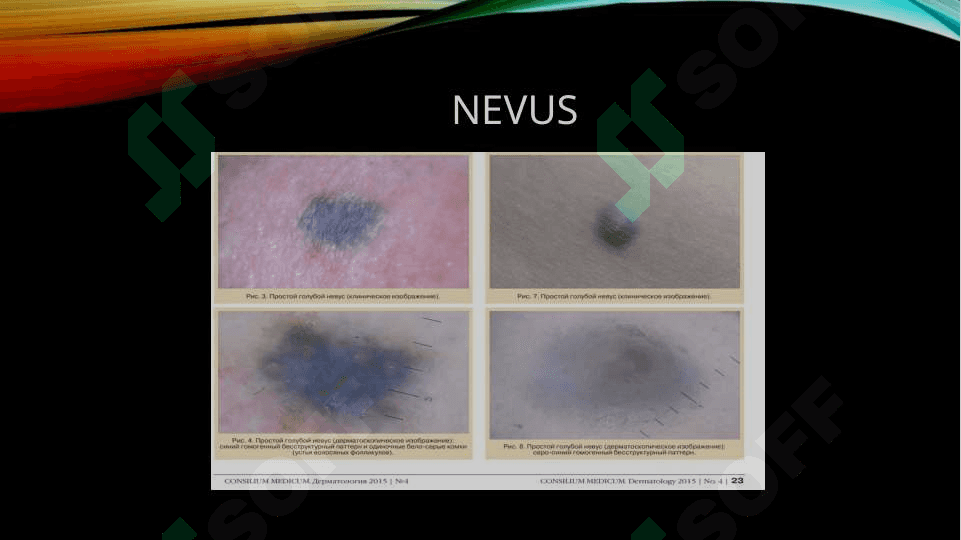 Nevus 3
