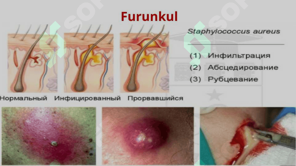 Xirurgik infeksiya 8