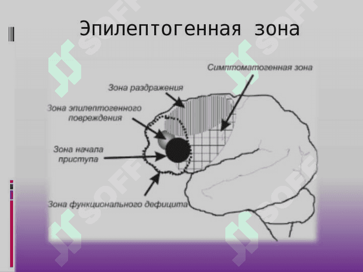 Эпилепсия хирургическое лечение 5
