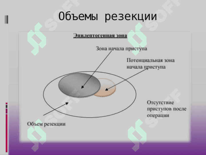 Эпилепсия хирургическое лечение 8