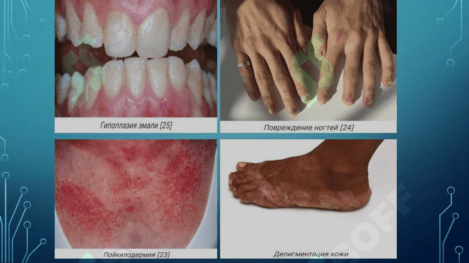 Bullyoz epidermoliz. Xeyli-Xeyli kasalligi. Chuqur mikozlar 7
