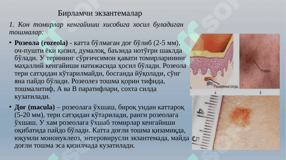 ЭКЗАНТЕМАЛАР БИЛАН КЕЧУВЧИ  ЮКУМЛИ  КАСАЛЛИКЛАРХАКИДА УМУМИЙ ТУШУНЧА 5