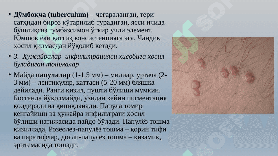 ЭКЗАНТЕМАЛАР БИЛАН КЕЧУВЧИ  ЮКУМЛИ  КАСАЛЛИКЛАРХАКИДА УМУМИЙ ТУШУНЧА 7