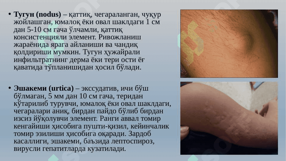 ЭКЗАНТЕМАЛАР БИЛАН КЕЧУВЧИ  ЮКУМЛИ  КАСАЛЛИКЛАРХАКИДА УМУМИЙ ТУШУНЧА 8
