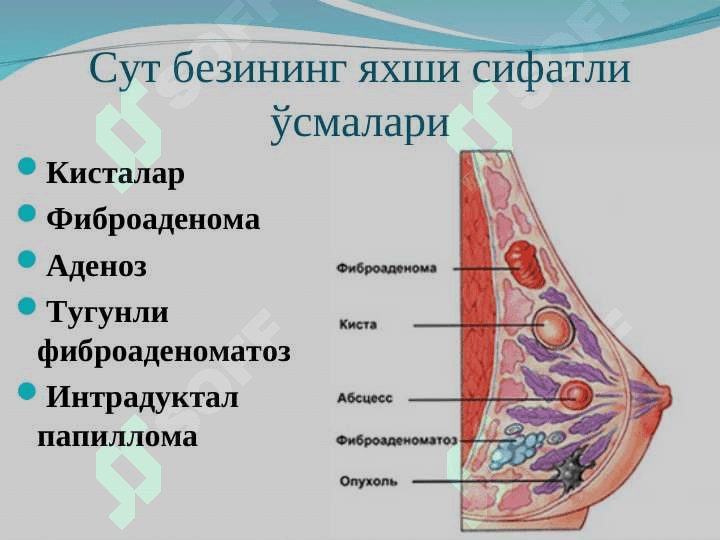 Сут бези  саратони 6