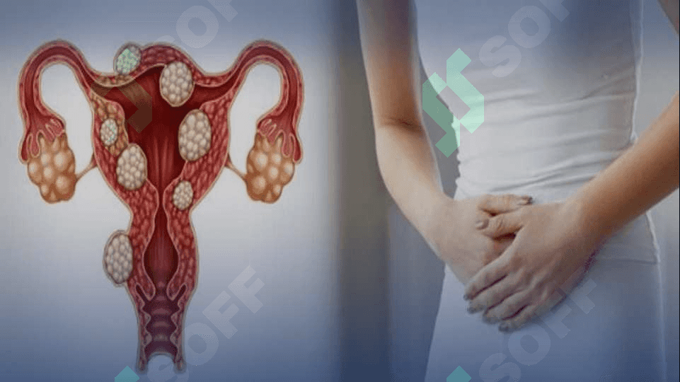 Bachadon miomasi. Endometrioz. Etiopatogenezi, tasnifi, klinikasi, tashxislash, davolash tamoyillari 3