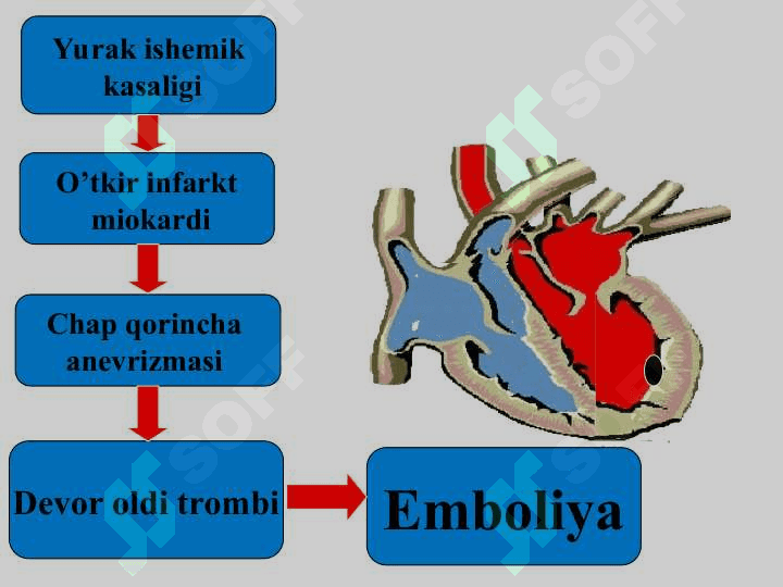 O‘tkir arterial tromboz va emboliyalar 6