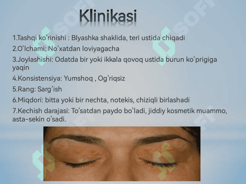 Ksantelazma. Lipoma. Gigroma 4