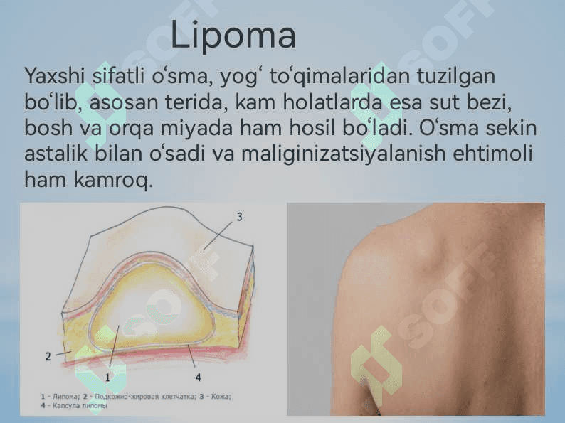 Ksantelazma. Lipoma. Gigroma 7