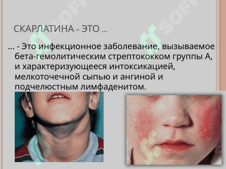 СКАРЛАТИНА 2
