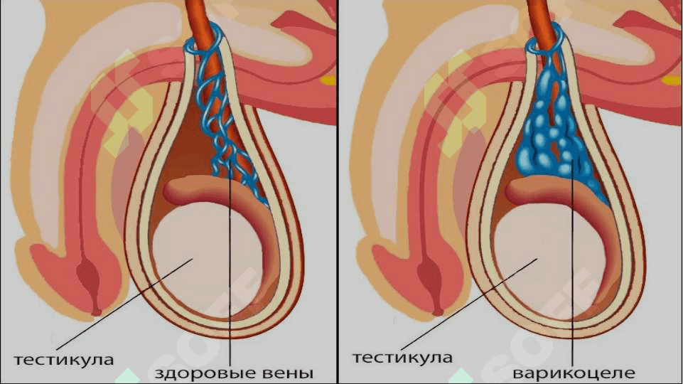 Varikosele. Peyroni kasalligi. 4