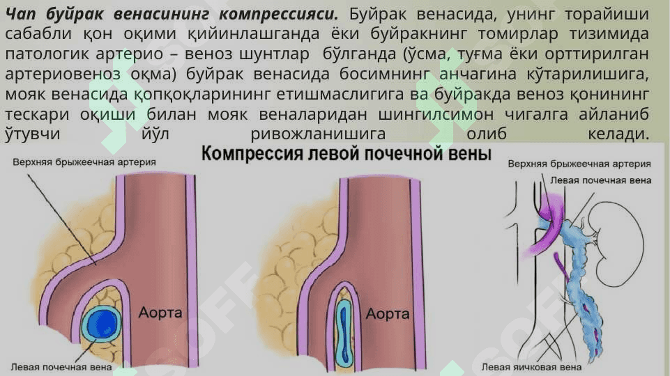Varikosele. Peyroni kasalligi. 6