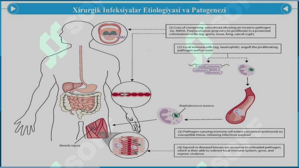 Umumiy Xirurgik Infeksiya - Умумий Хирургик Инфекция 6