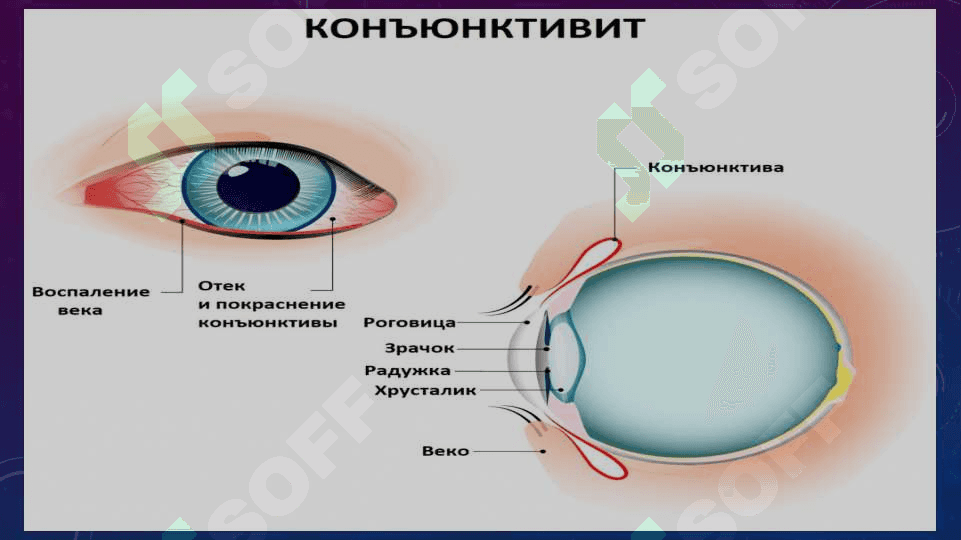 Konyunktiva tuzilishi funksiyasi Bakterial Konyuktivit 5