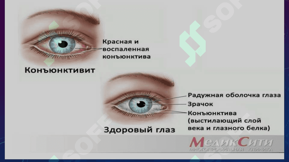 Konyunktiva tuzilishi funksiyasi Bakterial Konyuktivit 6
