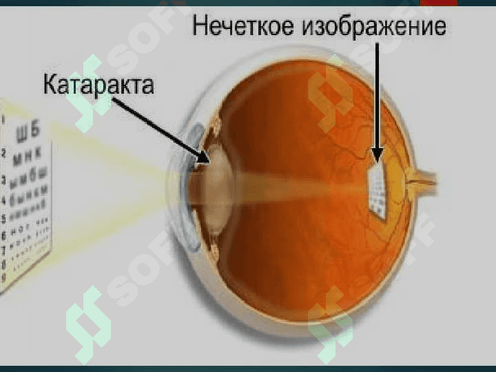 Kataraktani zamonaviy davolash usullari 3