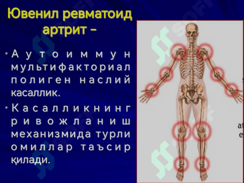 ЮВЕНИЛ РЕВМАТОИД АРТРИТ JUVENILE RHEUMATOID ARTHRITIS 4