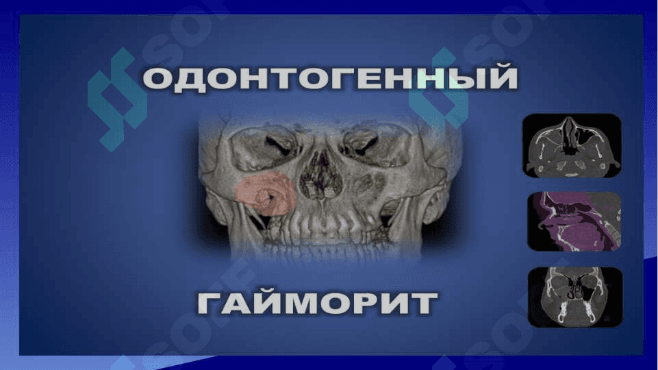 Odontogen gaymorit . Tashxislash va davolash usullari algoritmlari . Yuqori jag' bo'shlig'i perforatsiyasi . Tashxislash va davolash usullari algoritmlari 2
