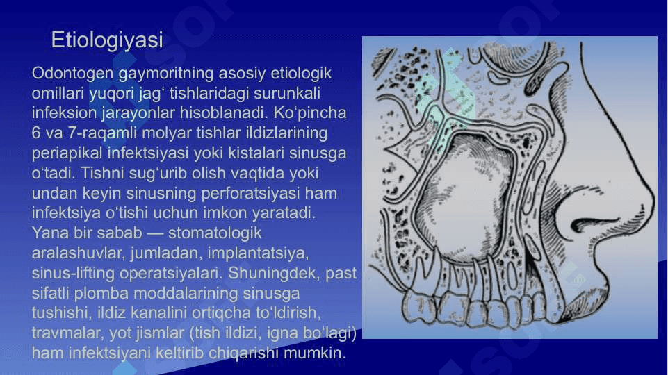 Odontogen gaymorit . Tashxislash va davolash usullari algoritmlari . Yuqori jag' bo'shlig'i perforatsiyasi . Tashxislash va davolash usullari algoritmlari 4