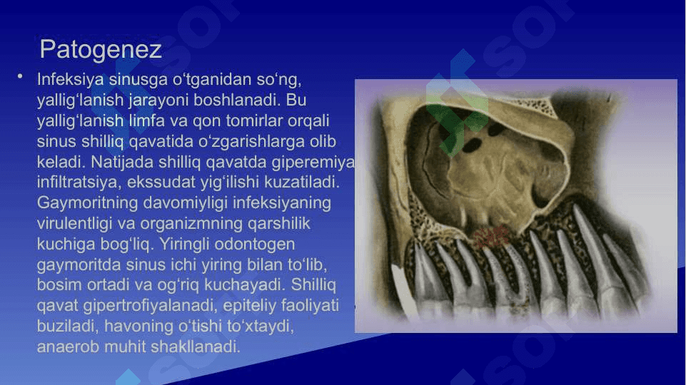 Odontogen gaymorit . Tashxislash va davolash usullari algoritmlari . Yuqori jag' bo'shlig'i perforatsiyasi . Tashxislash va davolash usullari algoritmlari 5