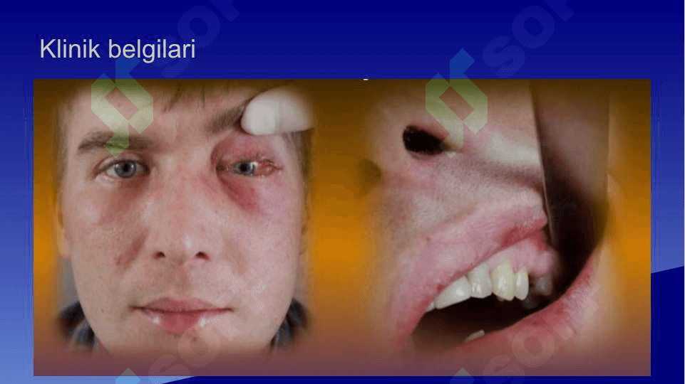 Odontogen gaymorit . Tashxislash va davolash usullari algoritmlari . Yuqori jag' bo'shlig'i perforatsiyasi . Tashxislash va davolash usullari algoritmlari 8