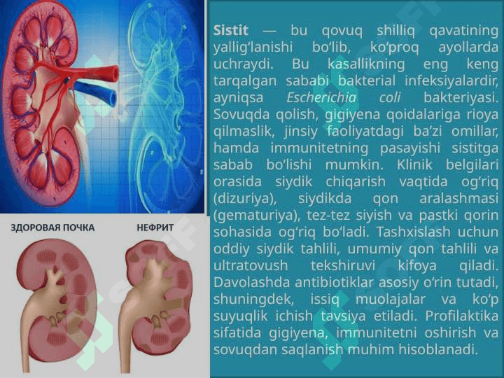 Sistit, Nefrit, Perit, qovuqni yalligʻlanishi T.pptx 4