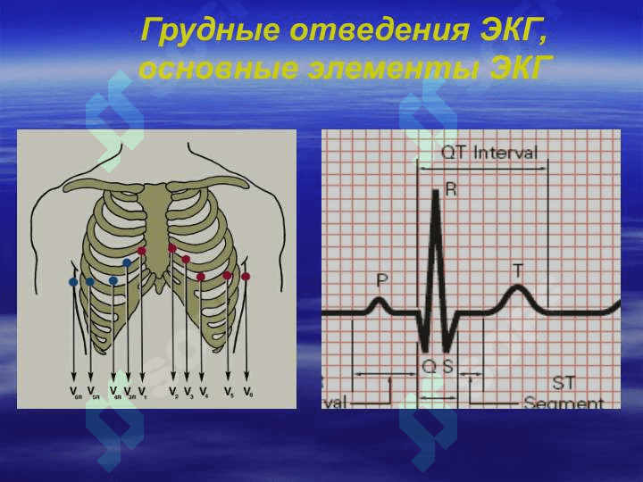 Аритмии у детей 4