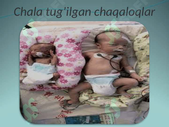 Chala tug’ilgan chaqaloqlar 5