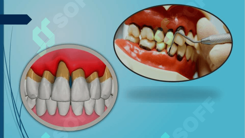 Bolalarda parodontoz 8