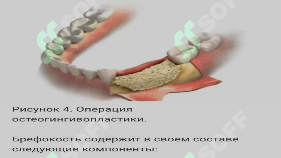 Parodontal xirurgiyada qattiq to'qimalar transplantatsiyasi va plastikasi 5