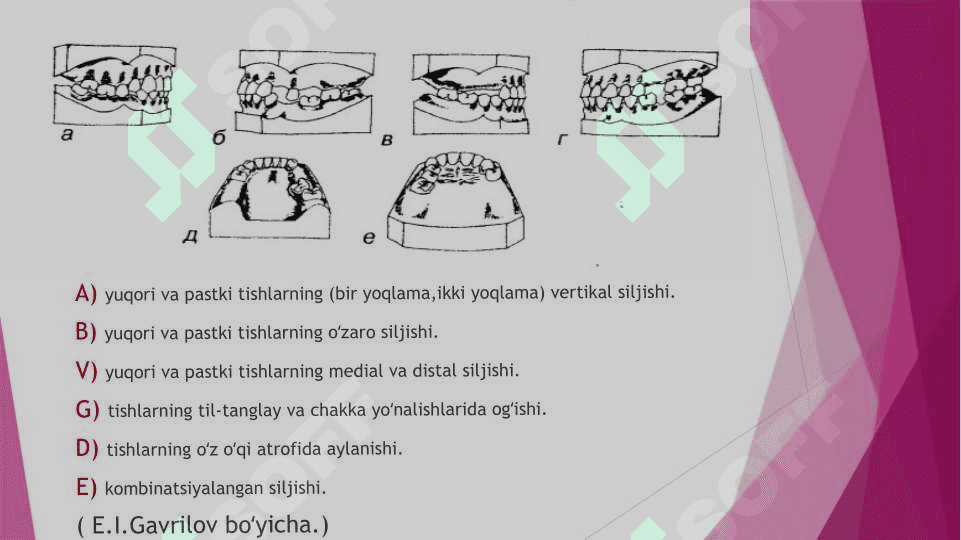 Tish qatori deformatsiyalarini            Gavrilov va Ponomaryova boʻyicha tasniflari 5