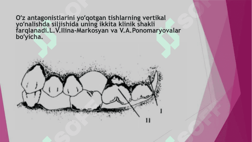 Tish qatori deformatsiyalarini   Gavrilov va Ponomaryova boʻyicha tasniflari 7