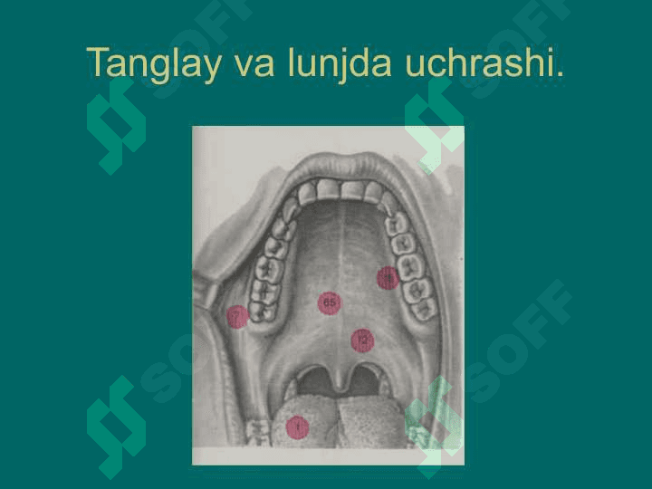 Til, lunj, tanglay va og'iz tubi o'smalari 4