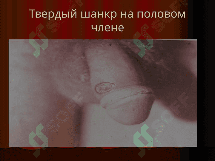 Сифилис 6