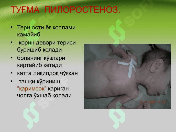 Tug'ma pilerostenoz , Bolalarda qusish sindromi . Туғма пилеростеноз, болаларда қусиш синдроми 4