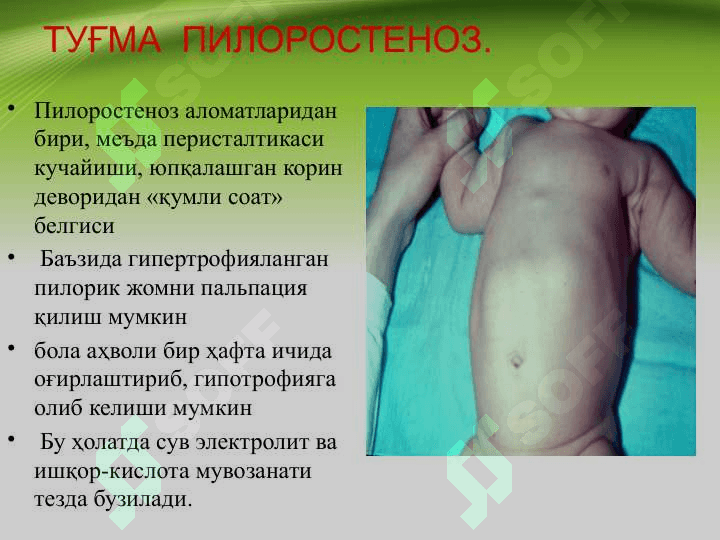 Tug'ma pilerostenoz , Bolalarda qusish sindromi . Туғма пилеростеноз, болаларда қусиш синдроми 5