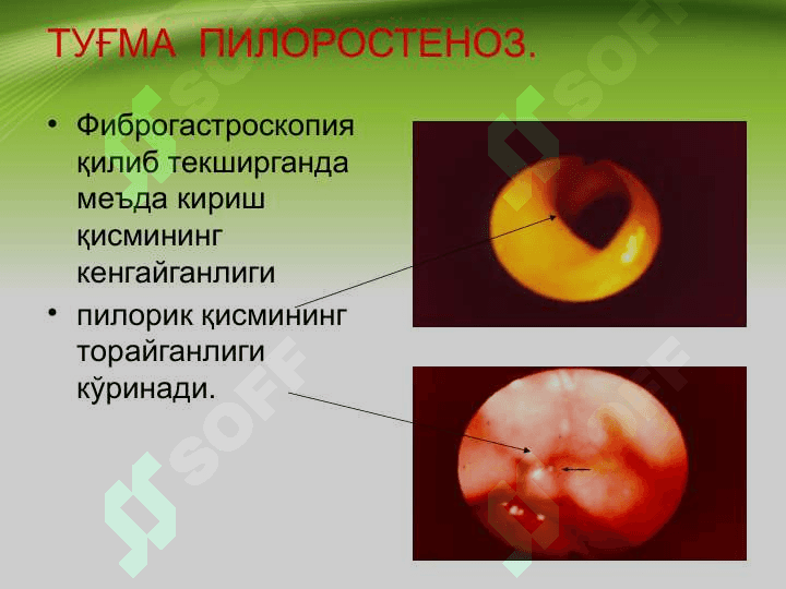 Tug'ma pilerostenoz , Bolalarda qusish sindromi . Туғма пилеростеноз, болаларда қусиш синдроми 7