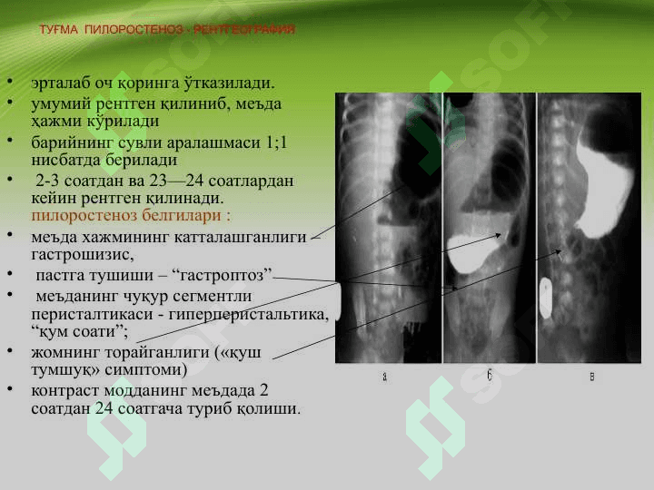 Tug'ma pilerostenoz , Bolalarda qusish sindromi . Туғма пилеростеноз, болаларда қусиш синдроми 8