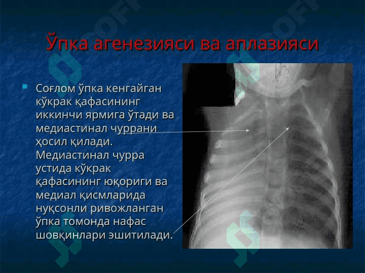 Ўпкаларнинг туғма ривожланиш нуқсонлари ва аномалиялари Диафрагма туғма чурралари 7