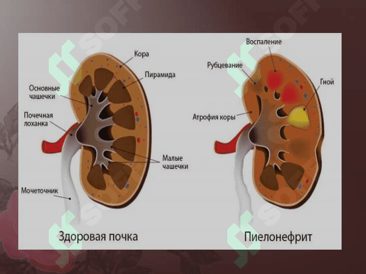 O`tkir va surunkali piyelonefrit. Simptomlari,asoratlari va davolash yo`llari. 5