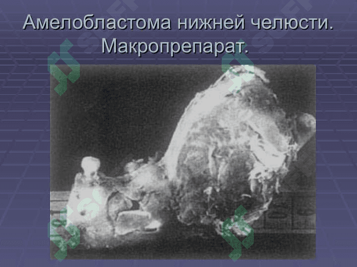 АМЕЛОБЛАСТОМА 7