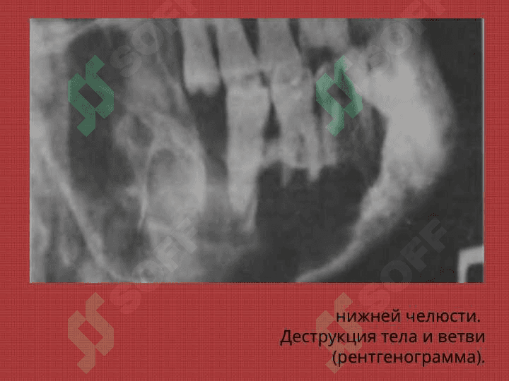 Опухоли челюстно-лицевой области 8