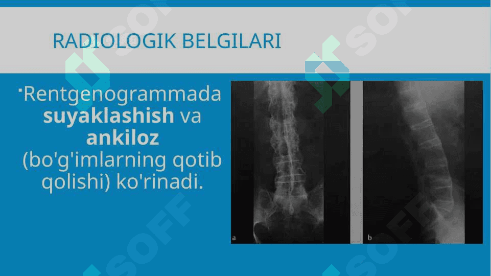 Umurtqa yallig’lanish va degenerativ distrofik kasalliklari 5