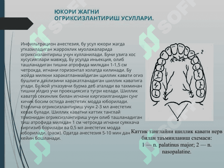 Tish olishda qo’llaniladigan og’riqsizlantirish usullari 4