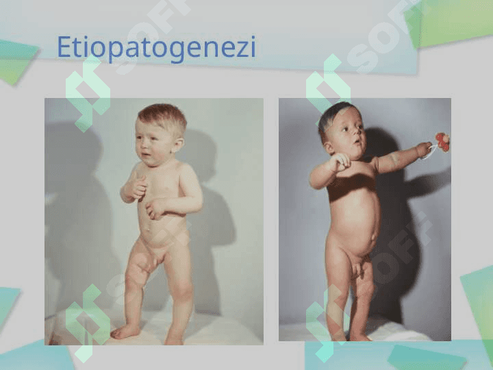 RAXITSIMON KASALLIK GIPERVITAMINOZ- D 4