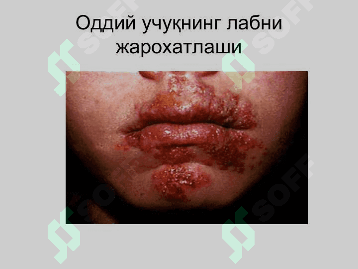 Терининг вирусли касалликлари 5